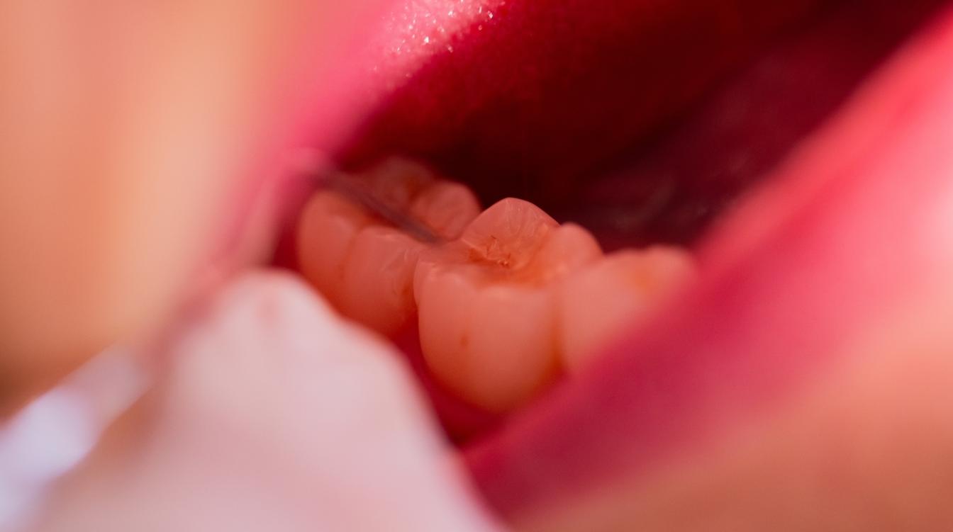 Стоматолог рассказал, когда нужно удалять зуб мудрости